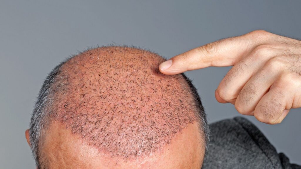 Patient undergoing FUT Hair Transplant in Delhi at Sarayu Clinics, showcasing the strip harvesting technique for hair restoration.