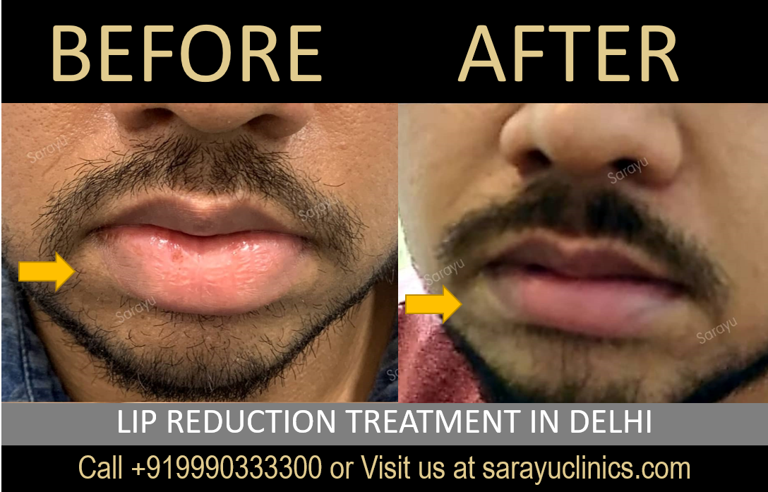 Dr. Adarsh Tripathi, Lip Reduction Surgeon in Delhi, showcasing enhanced facial aesthetics with balanced lips.