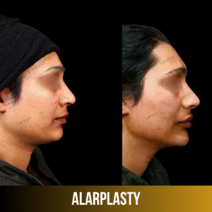 Best Alarplasty Surgeon in Delhi Dr Adarsh Tripathi