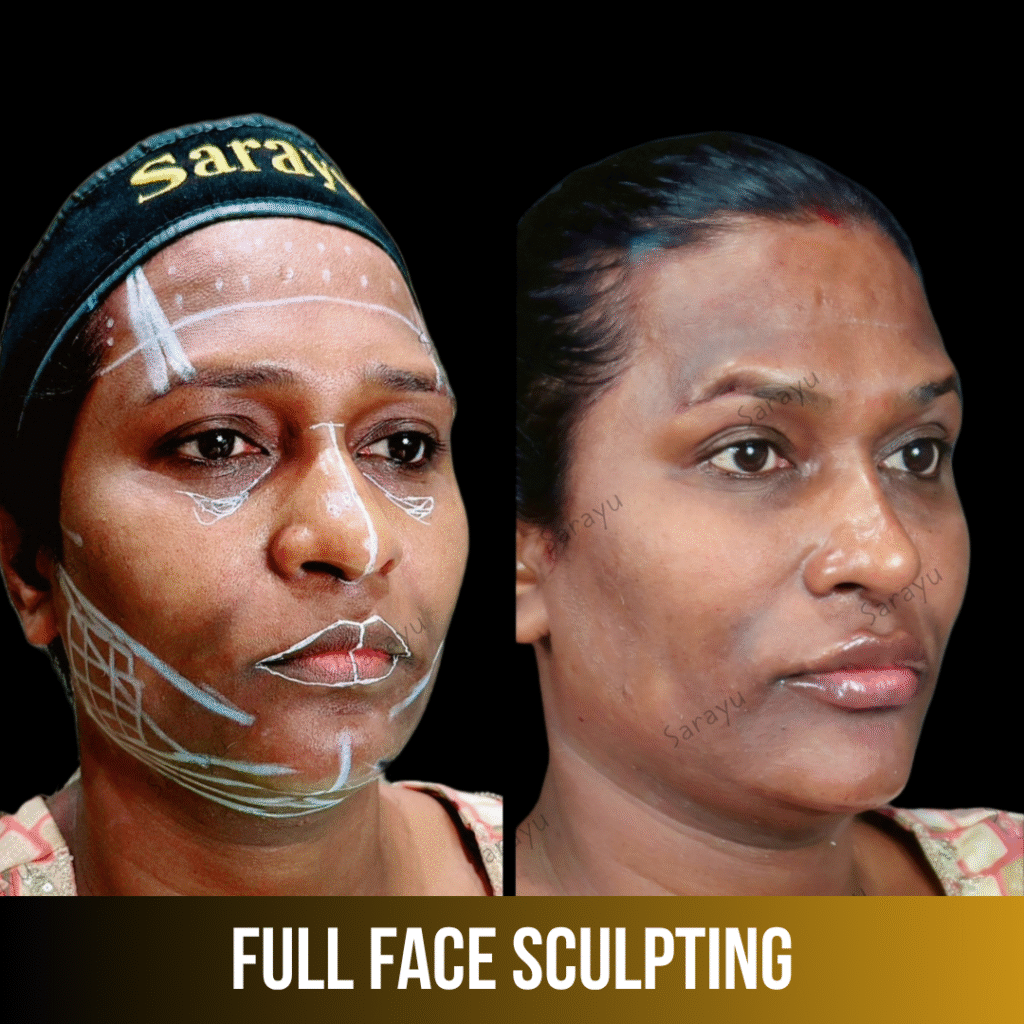 Affordable Full Face Sculpting Clinic in Delhi: Transform Your Look with Sarayu Clinics led by Dr. Adarsh Tripathi
