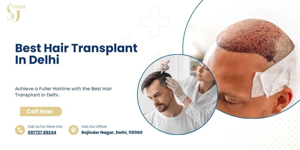 Best Hair Transplant Surgeaon in Delhi