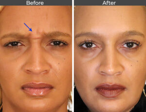 Botox-Before-and-After