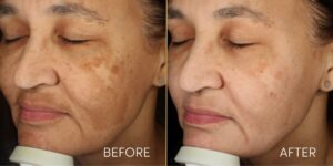 Before and after depigmentation treatment results at Sarayu Clinic