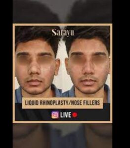 Best doctor for liquid rhinoplasty in Delhi before and after results