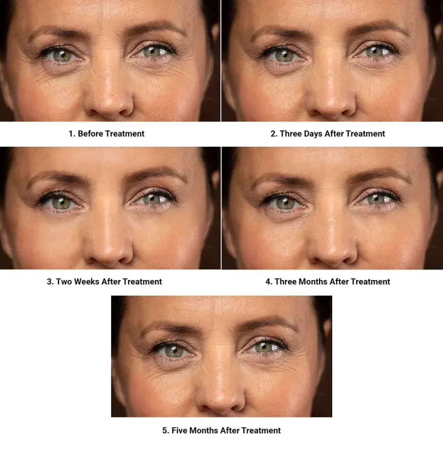 Botox Treatment Effects
