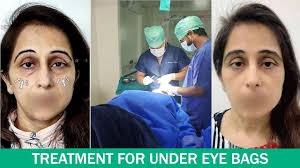 Best Blepharoplasty Doctor in Delhi. Dr. Adarsh Tripathi