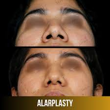 Best alarplasty surgeon in Delhi performing nostril reduction