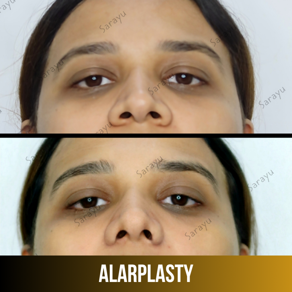 Diagram explaining alarplasty nostril and nasal base reduction