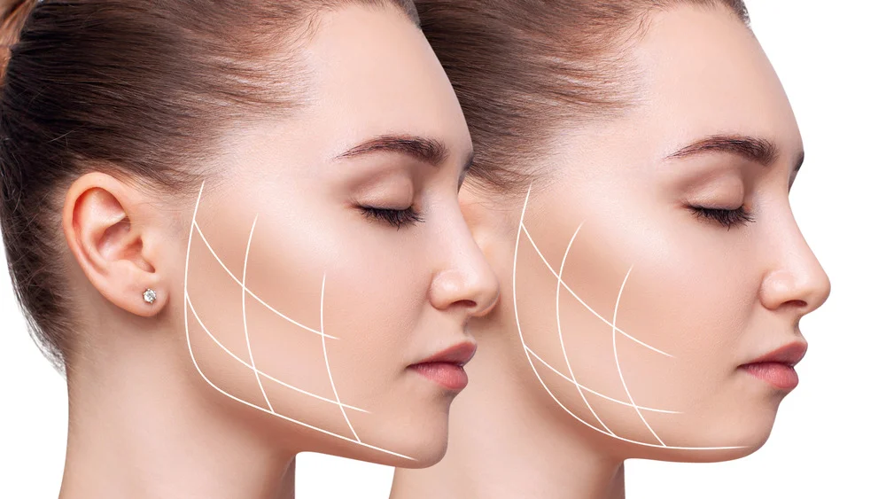Facial contouring guide lines on cheek, buccal fat removal in Delhi