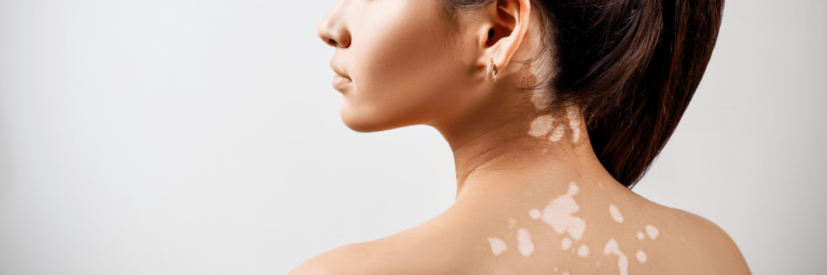 Close-up of even-toned skin achieved through depigmentation treatment